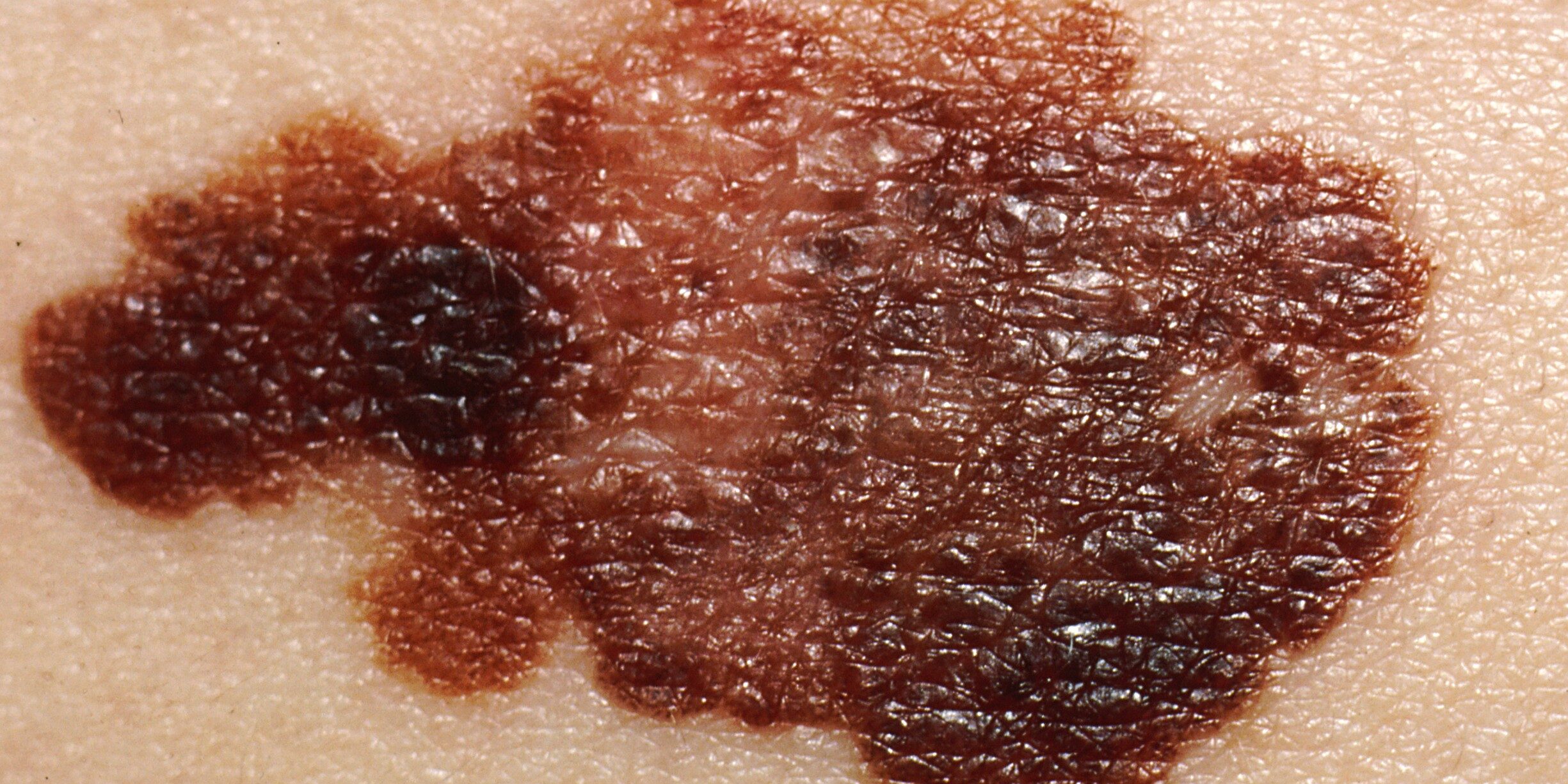 Close up of Melanoma